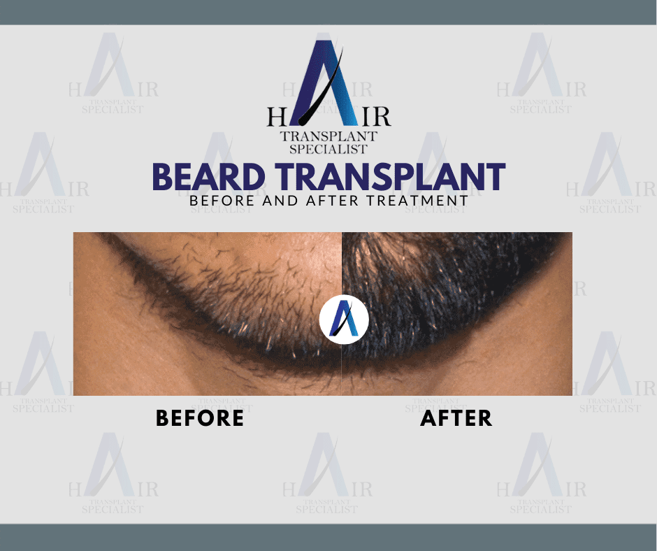 Hasil dan kesan yang berhasil untuk tanam janggut hanya di tanam rambut Malaysia