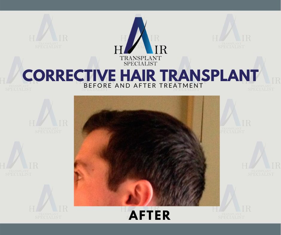 Hasil kesan sebelum Pembetulan Tanam Rambut hanya di Tanam Rambut Malaysia