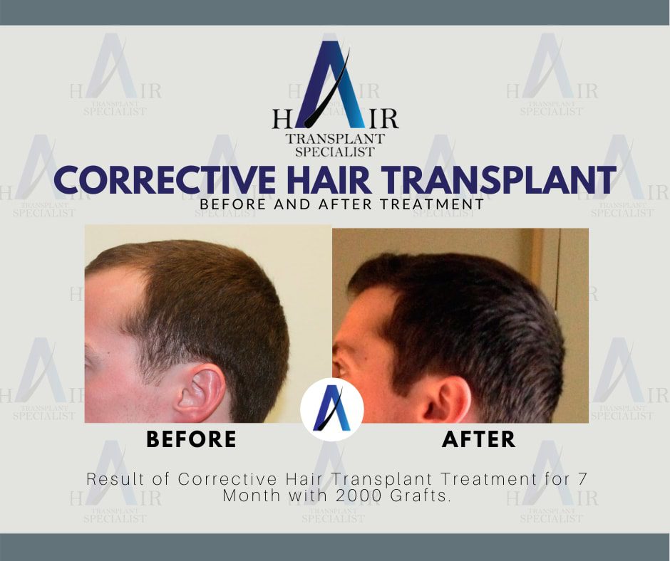 Hasil keputusan untuk Pembetulan Tanam Rambut yang terbaik hanya di Tanam Rambut Malaysia