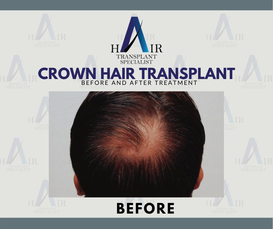 Hasil kesan sebelum Tanam Rambut Atas hanya di Tanam Rambut Malaysia