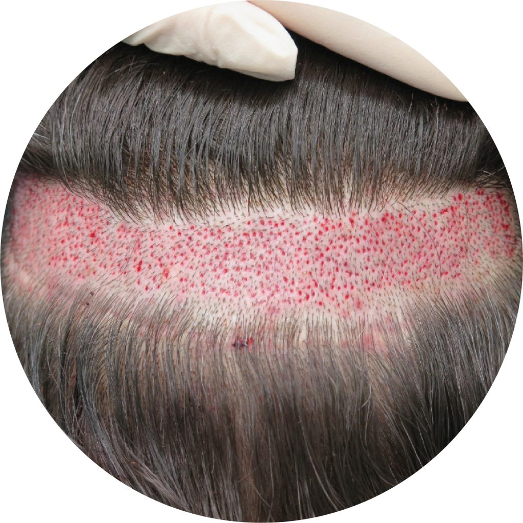 Proses penuaian rambut dalam bulat di Tanam Rambut Malaysia