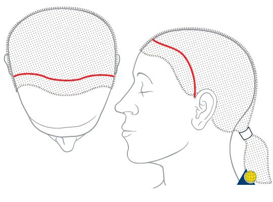 Segmen Rawatan Tanda Menurunkan Garis Rambut di Tanam Rambut Malaysia