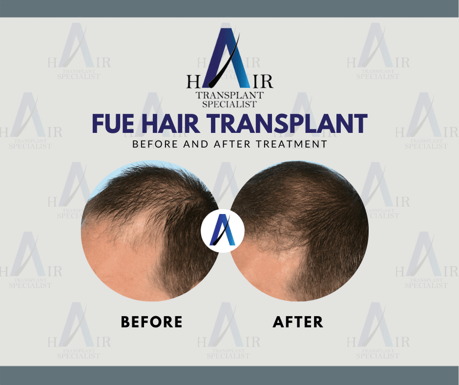 Hasil untuk kesan Tanam Rambut FUE yang berjaya hanya di Tanam Rambut Malaysia