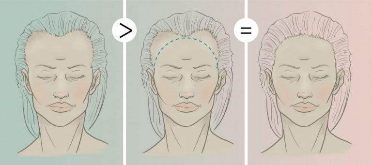 Langkah-Langkah untuk Rawatan Tanam Rambut Transgender di Tanam Rambut Malaysia