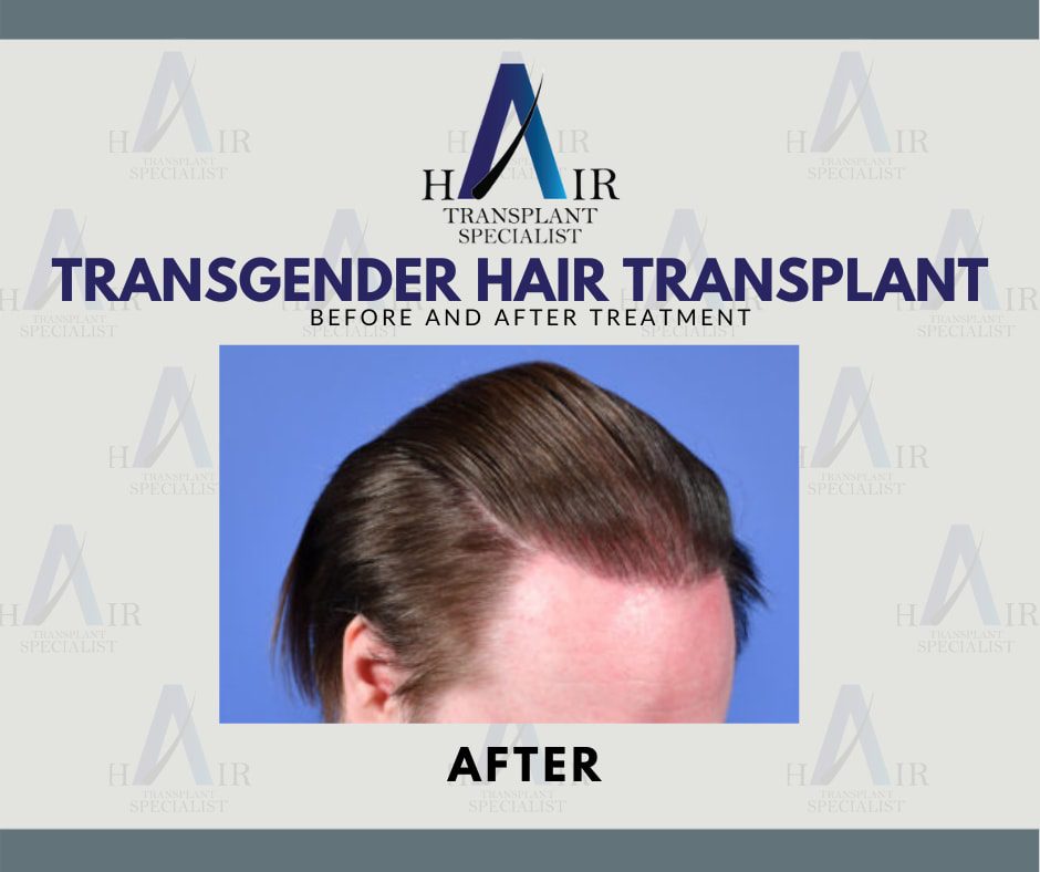 Hasil kesan selepas Tanam Rambut Transgender di Tanam Rambut Malaysia