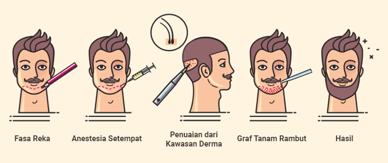 Proses Tanam Janggut di Tanam Rambut Malaysia