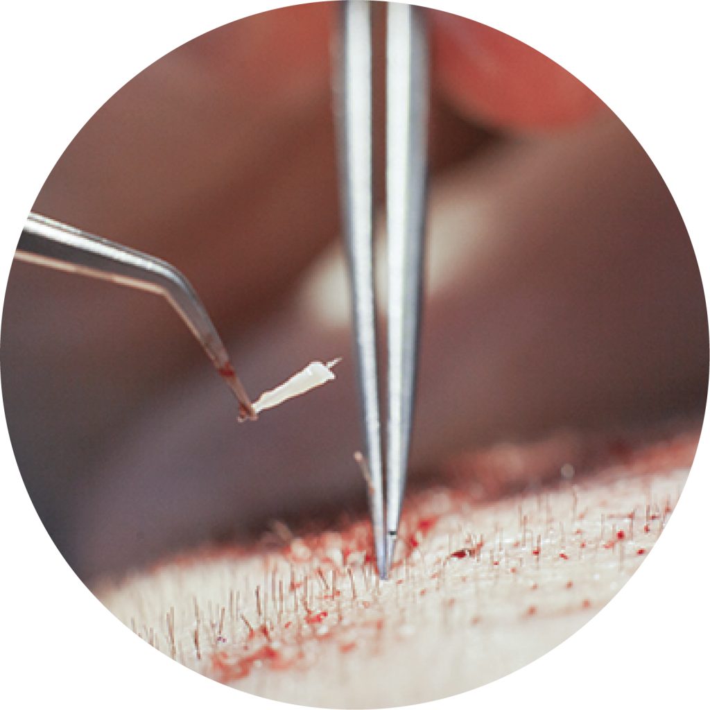 Penempatan cantuman rambut dalam bulat di tanam rambut Malaysia