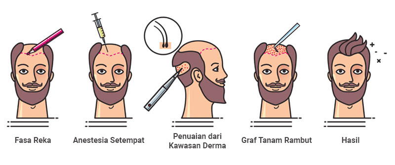 Proses Tanam Rambut FUE di tanam rambut Malaysia