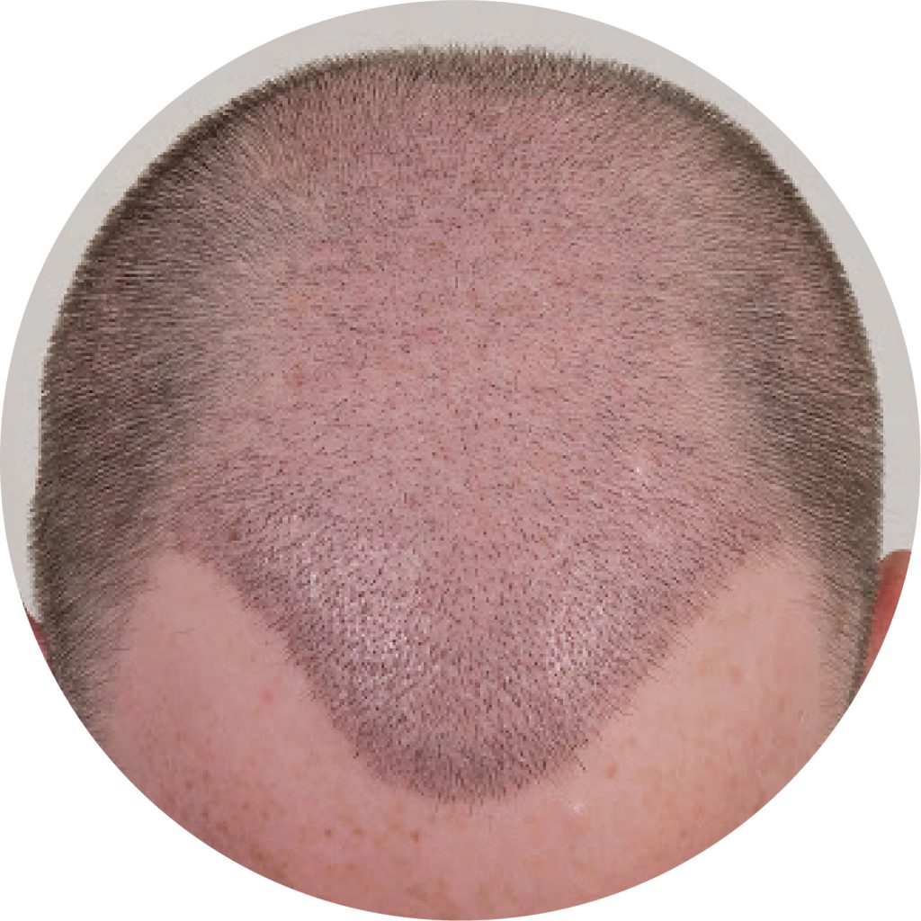 penciptaan tapak penerima dalam bulat di tanam rambut Malaysia