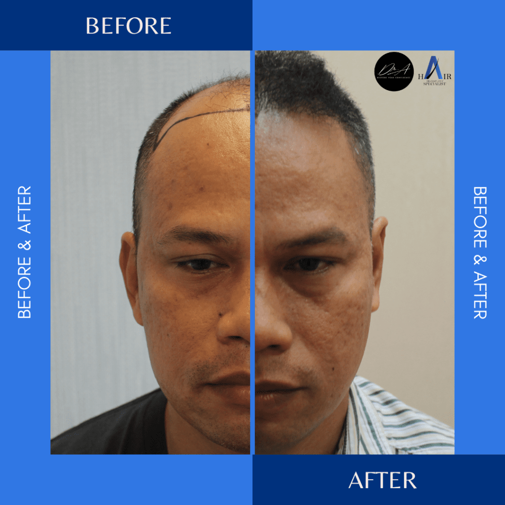 Tanam rambut mahkota sebelum dan selepas hasil rawatan